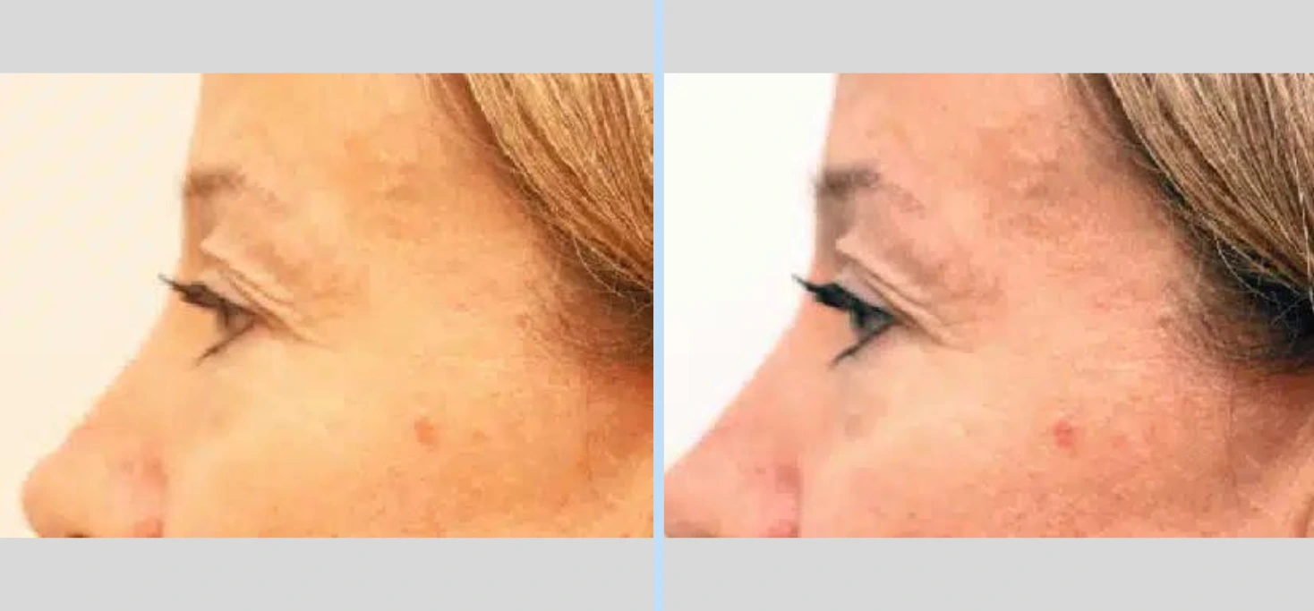 Blepharoplasty Before & After - Case 1