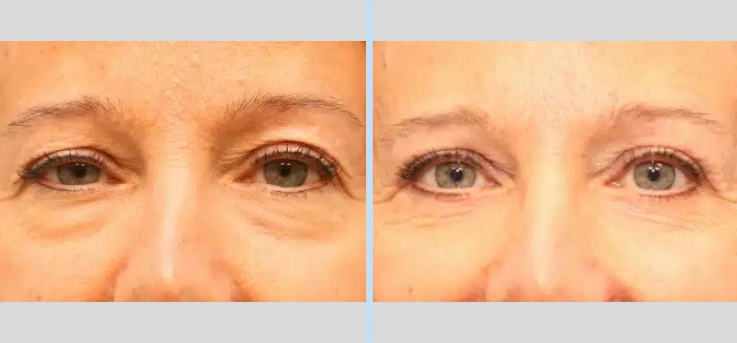 Blepharoplasty Before & After - Case 1