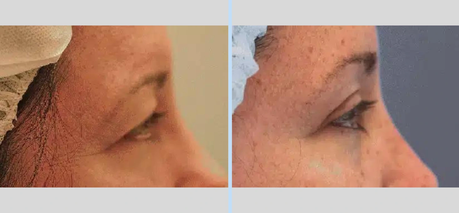 Blepharoplasty Before & After - Case 3