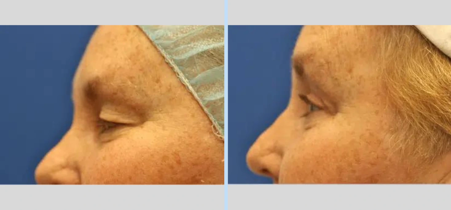 Blepharoplasty Before & After - Case 4
