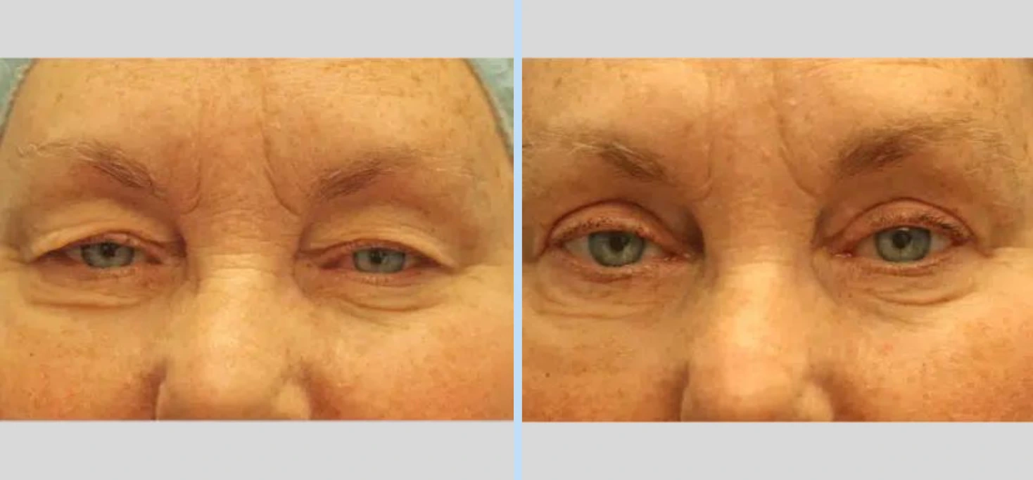Blepharoplasty Before & After - Case 4