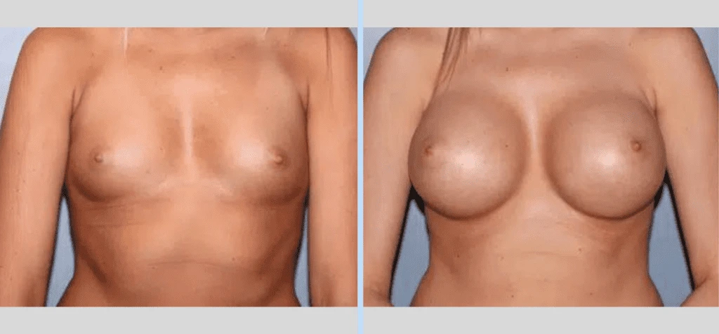 Breast Augmentation Before & After - Case 12 Banner