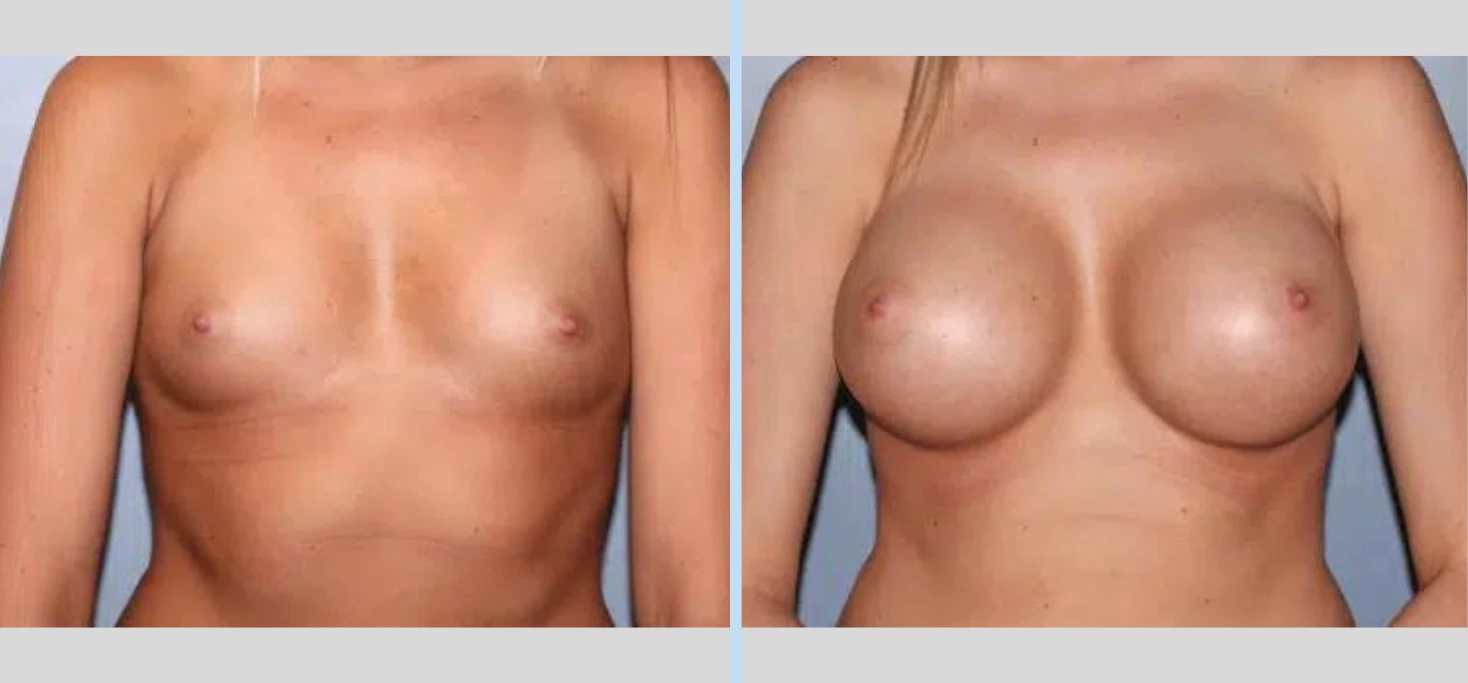 Breast Augmentation Before & After - Case 12 Banner