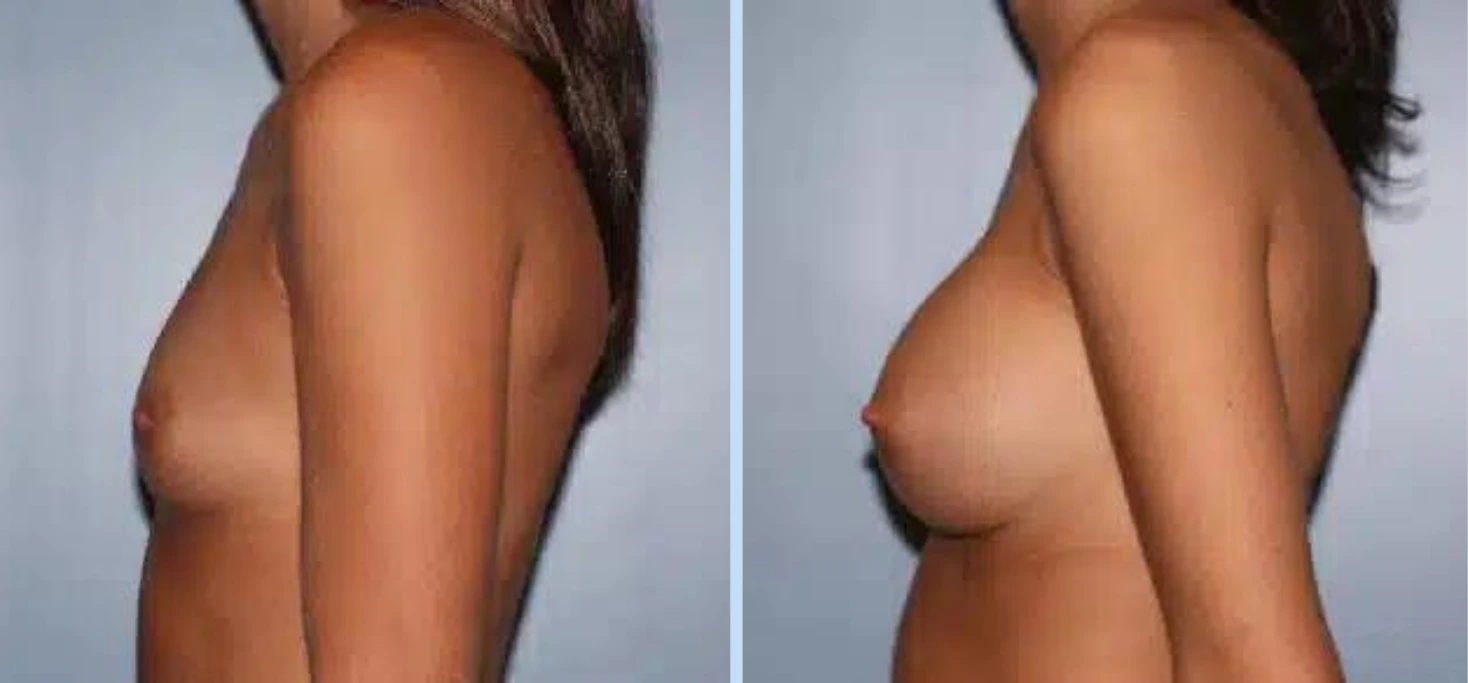 Breast Augmentation Before & After - Case 16 Banner
