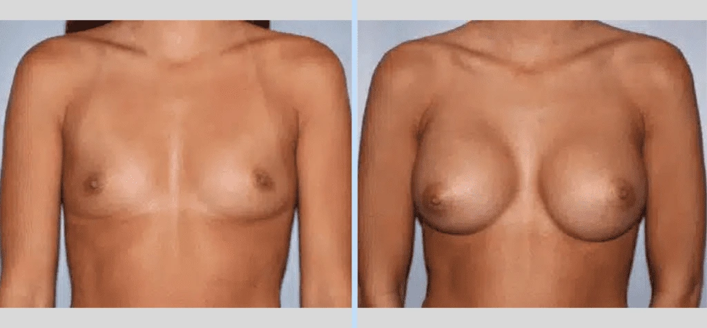 Breast Augmentation Before & After - Case 16 Banner