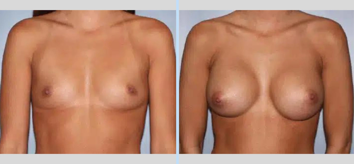 Breast Augmentation Before & After - Case 16 Banner