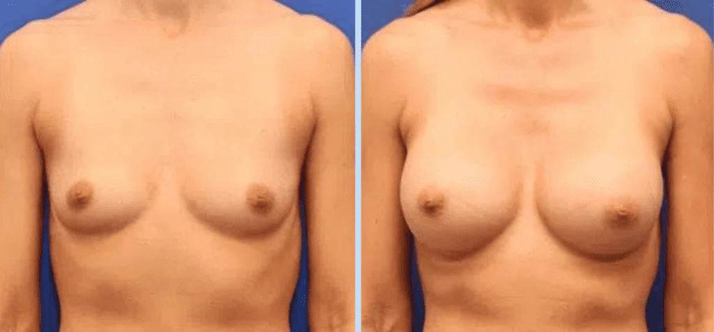 Breast Augmentation Before & After - Case 17 Banner