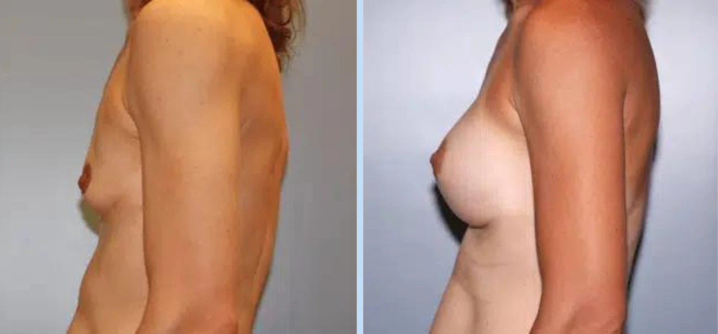 Breast Augmentation Before & After - Case 18 Banner