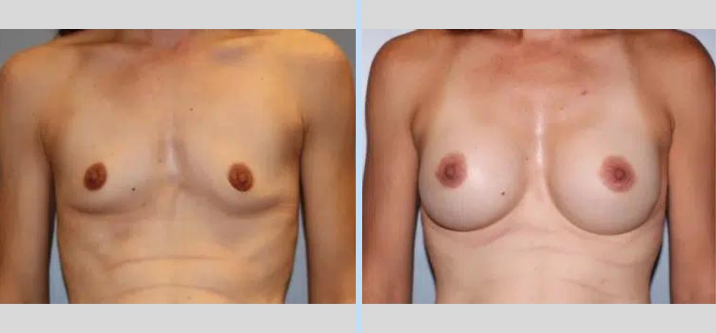 Breast Augmentation Before & After - Case 18 Banner
