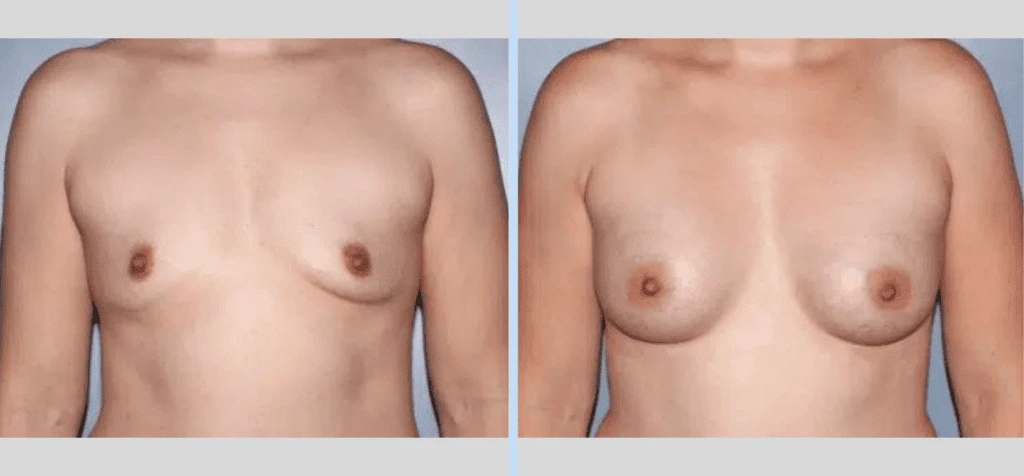 Breast Augmentation Before & After - Case 20