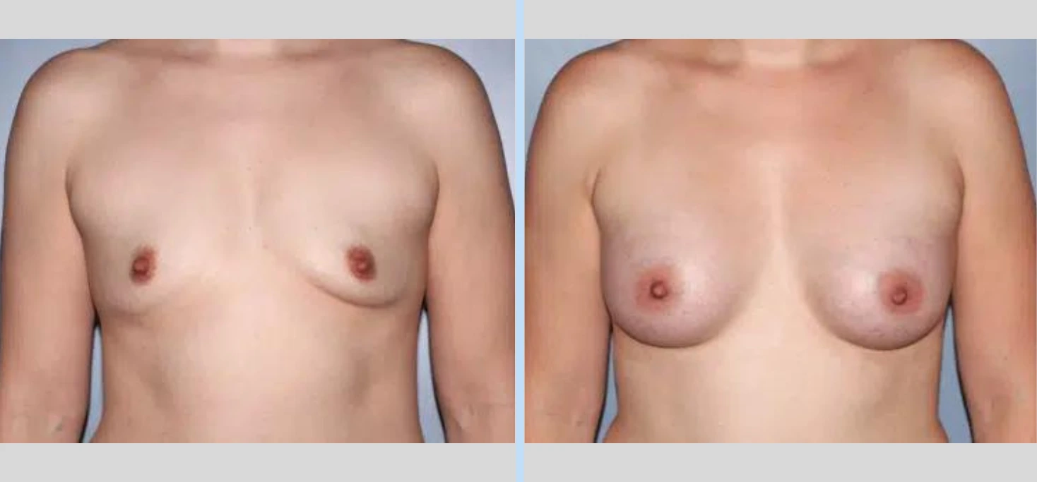 Breast Augmentation Before & After - Case 20