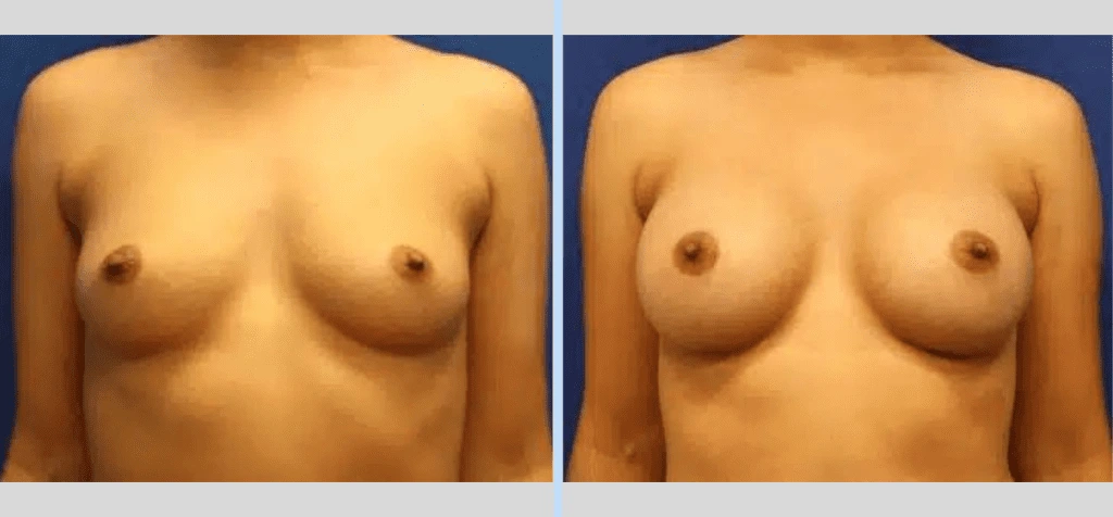 Breast Augmentation Before & After - Case 21