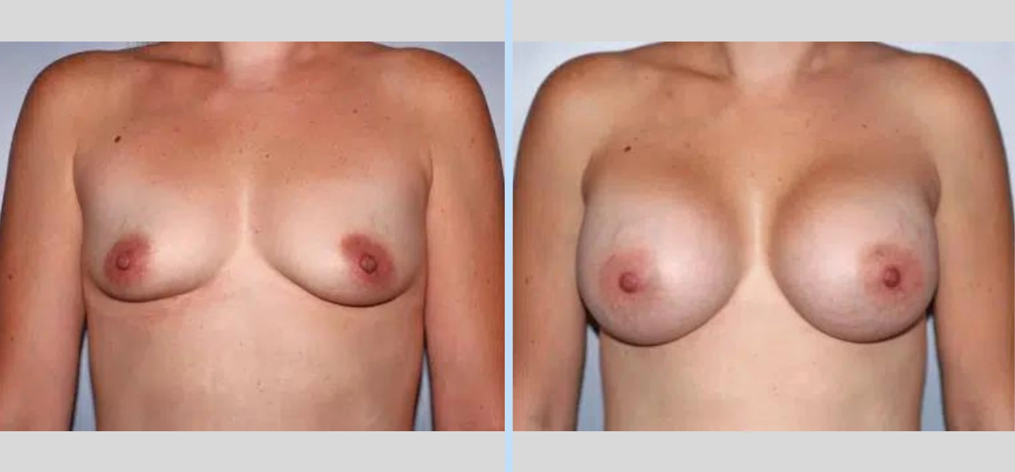 Breast Augmentation Before & After - Case 22