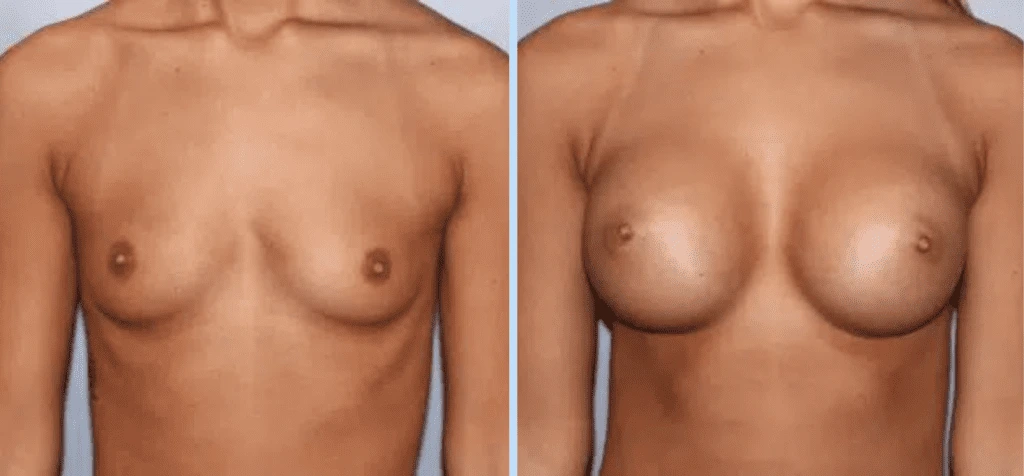 Breast Augmentation Before & After - Case 23