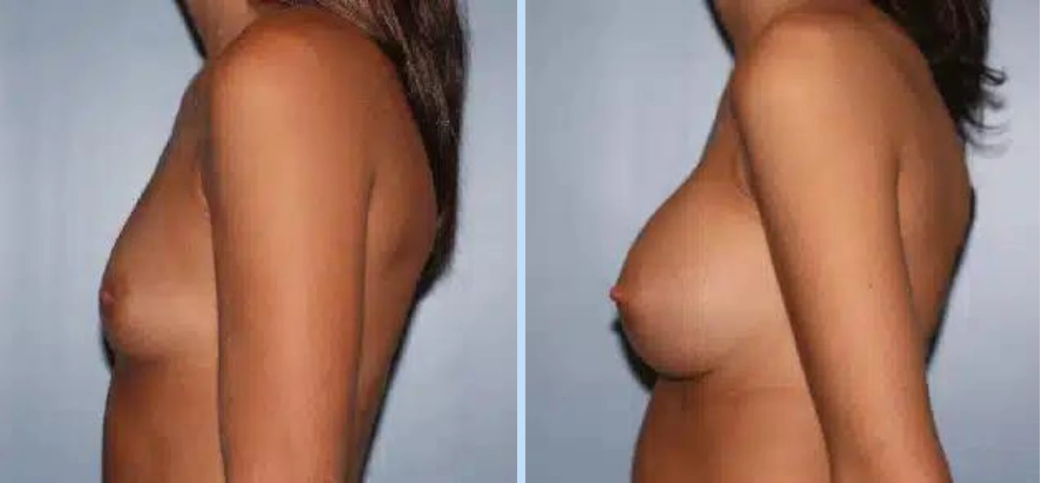Breast Augmentation Before & After - Case 24