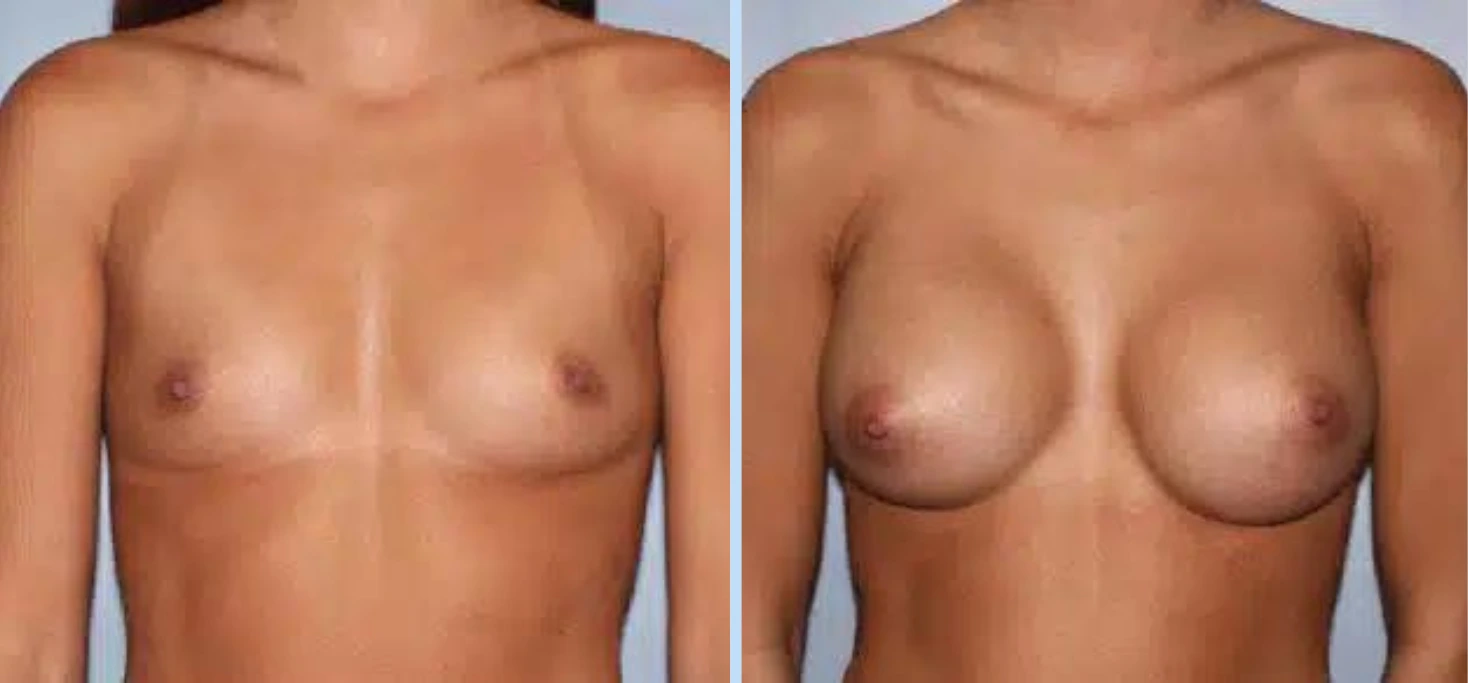 Breast Augmentation Before & After - Case 24