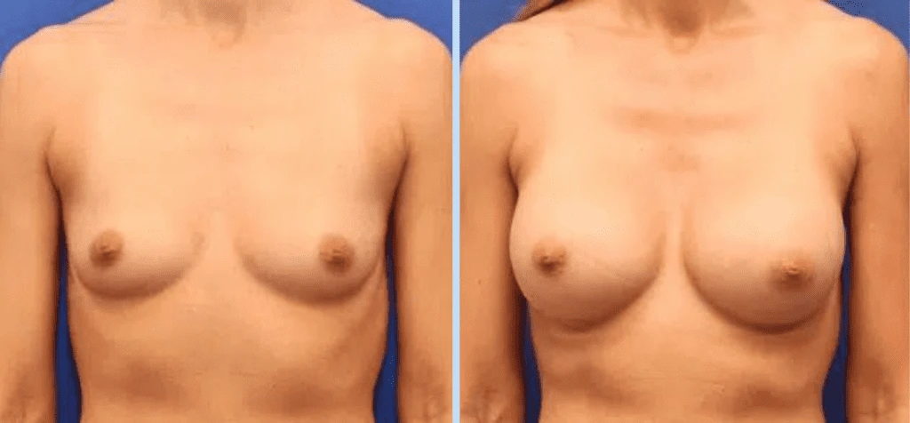 Breast Augmentation Before & After - Case 25