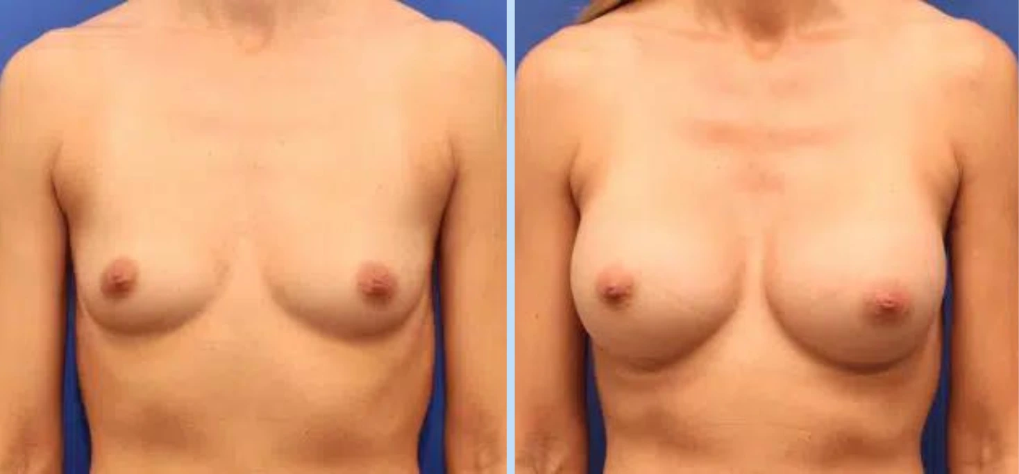 Breast Augmentation Before & After - Case 25