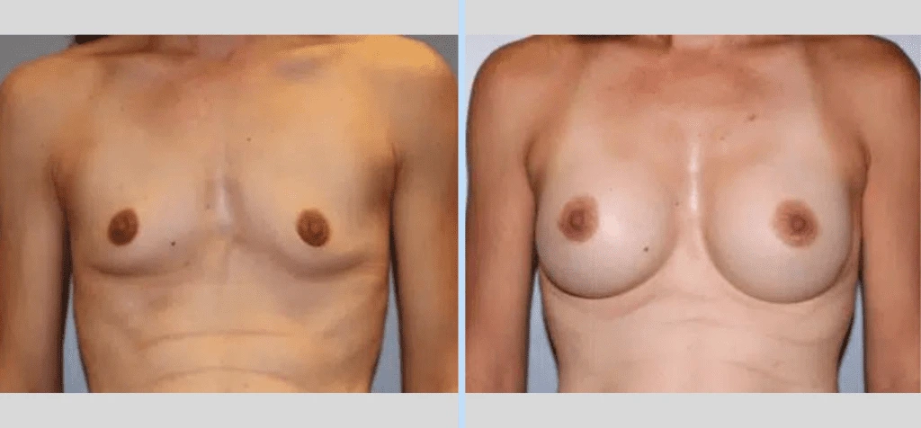 Breast Augmentation Before & After - Case 26