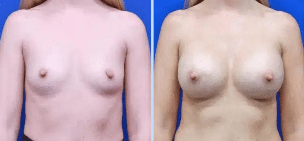 Breast Augmentation Before & After - Case 27