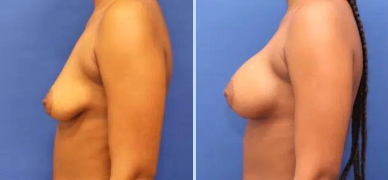 Breast Augmentation Before & After - Case 5 Banner