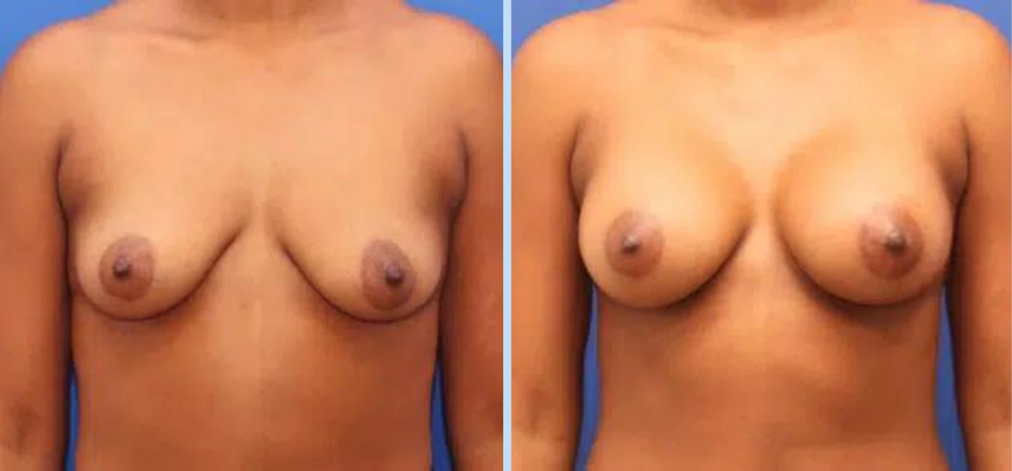 Breast Augmentation Before & After - Case 5 Banner