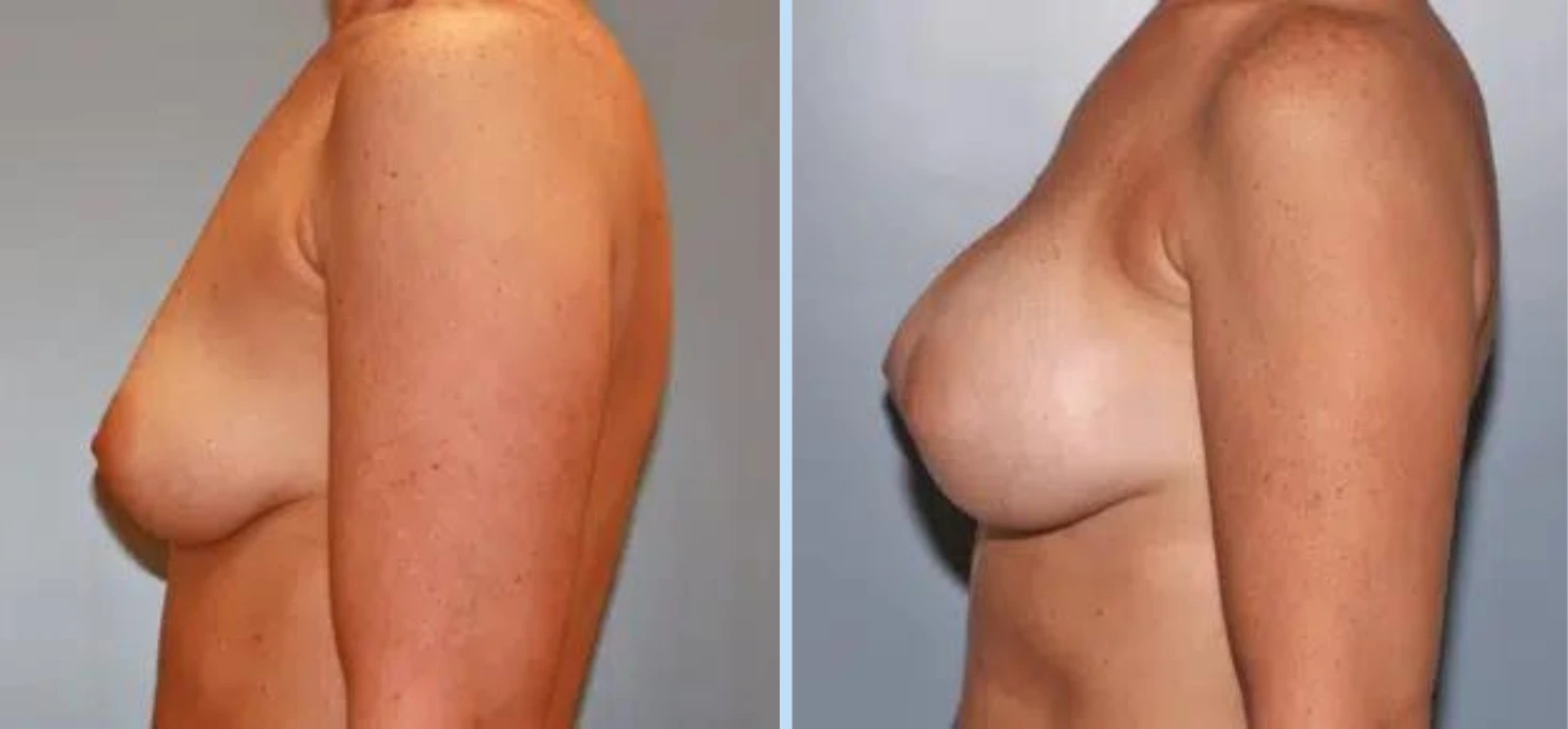 Breast Augmentation Before & After - Case 6 Banner