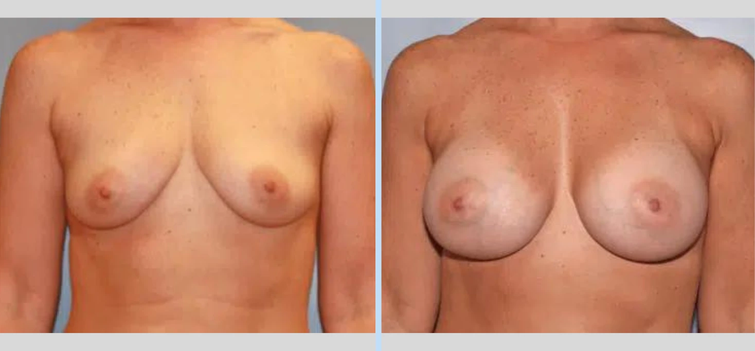 Breast Augmentation Before & After - Case 6 Banner