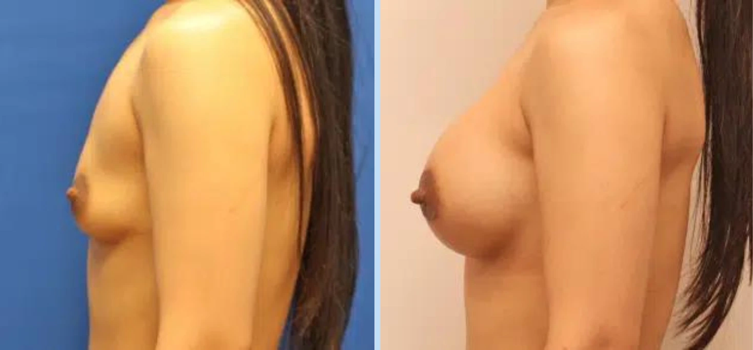 Breast Augmentation Before & After - Case 7 Banner