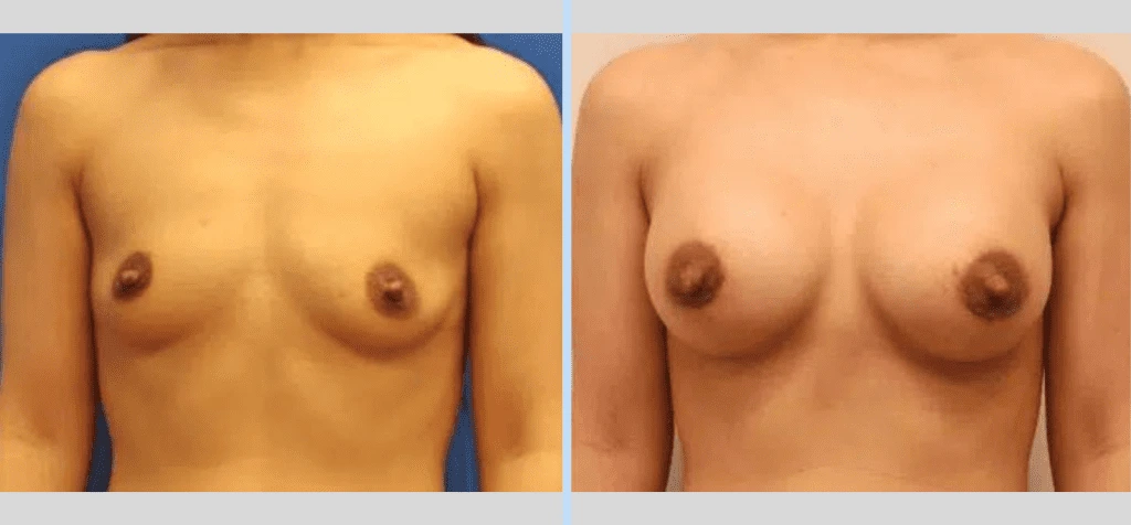 Breast Augmentation Before & After - Case 7 Banner