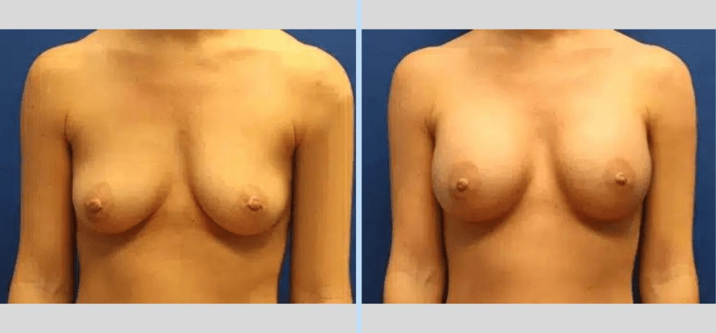 Breast Augmentation Before & After - Case 8 Banner