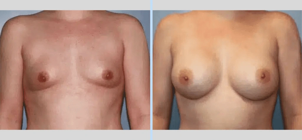 Breast Augmentation Before & After - Case 9 Banner