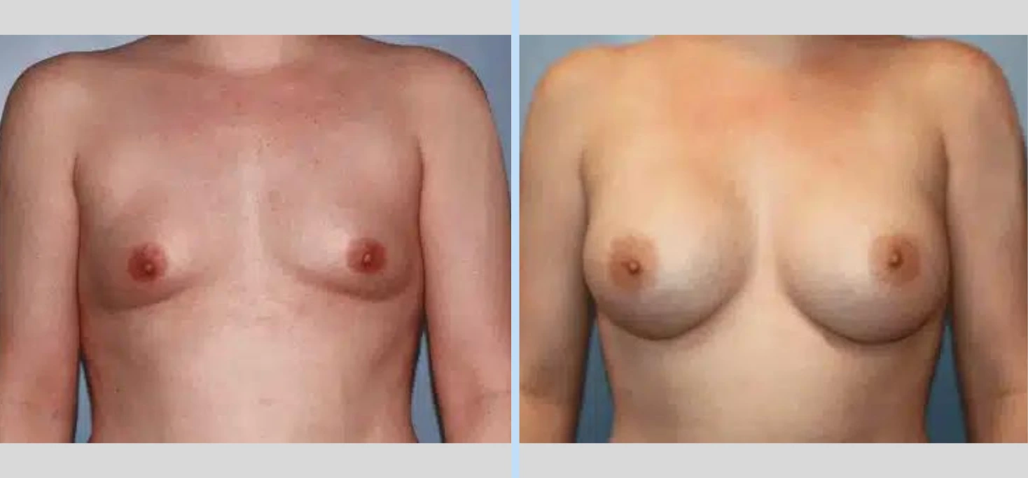 Breast Augmentation Before & After - Case 9 Banner