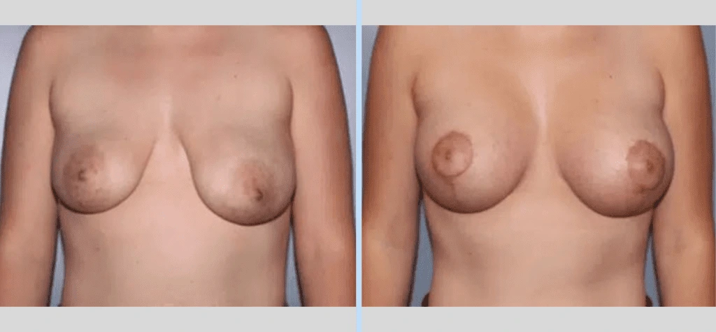 Breast Lift Before & After - Case 4