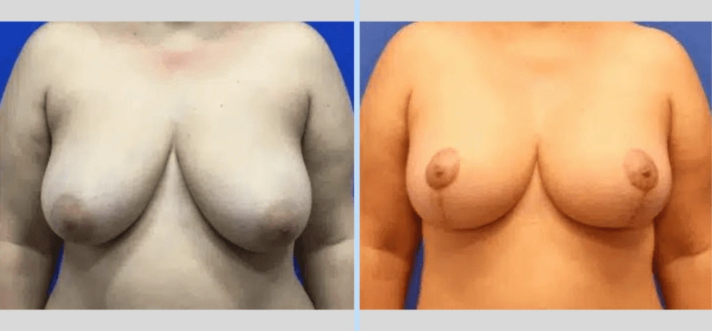 Breast Lift Before & After - Case 6