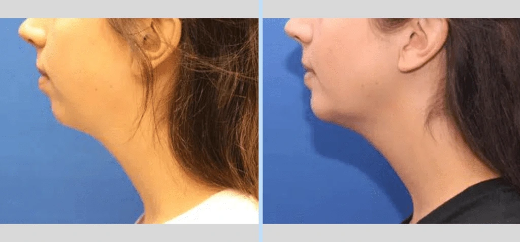 Chin Augmentation Before & After - Case 1