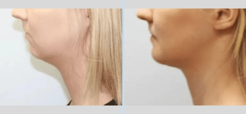 Chin Augmentation Before & After - Case 2