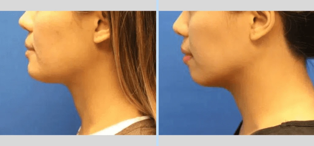 Chin Augmentation Before & After - Case 4