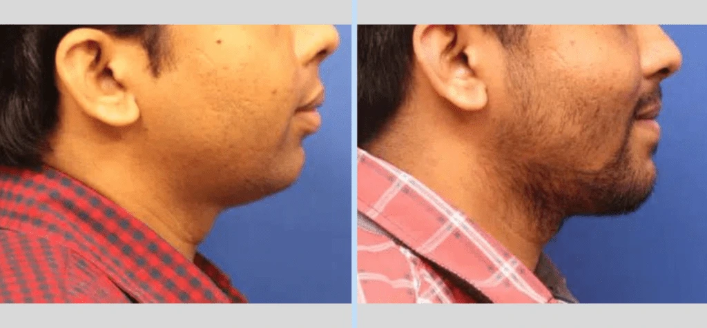 Chin Augmentation Before & After - Case 5