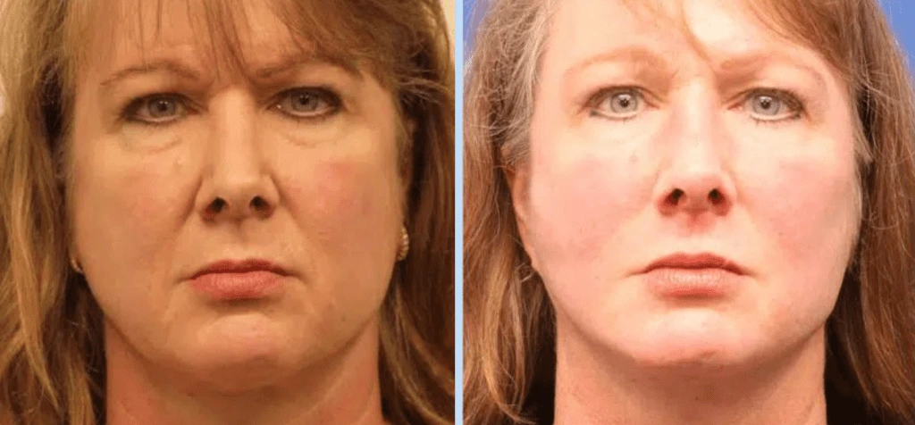Facelift Before & After - Case 3