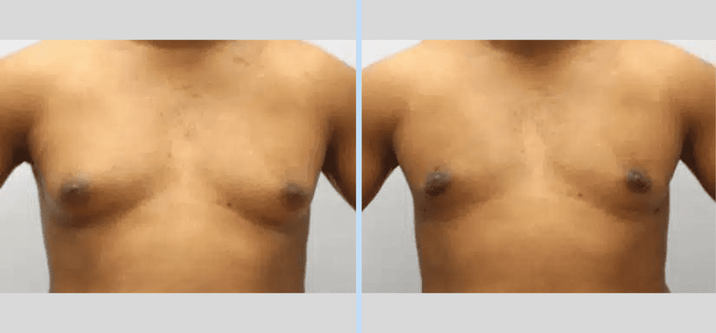 Gynecomastia Before & After - Case 3