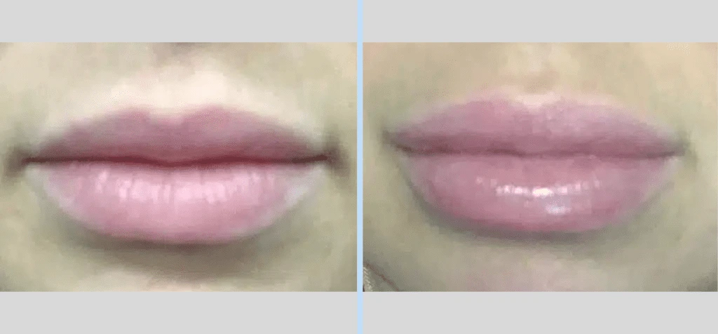 Injectables Before & After – Case 10