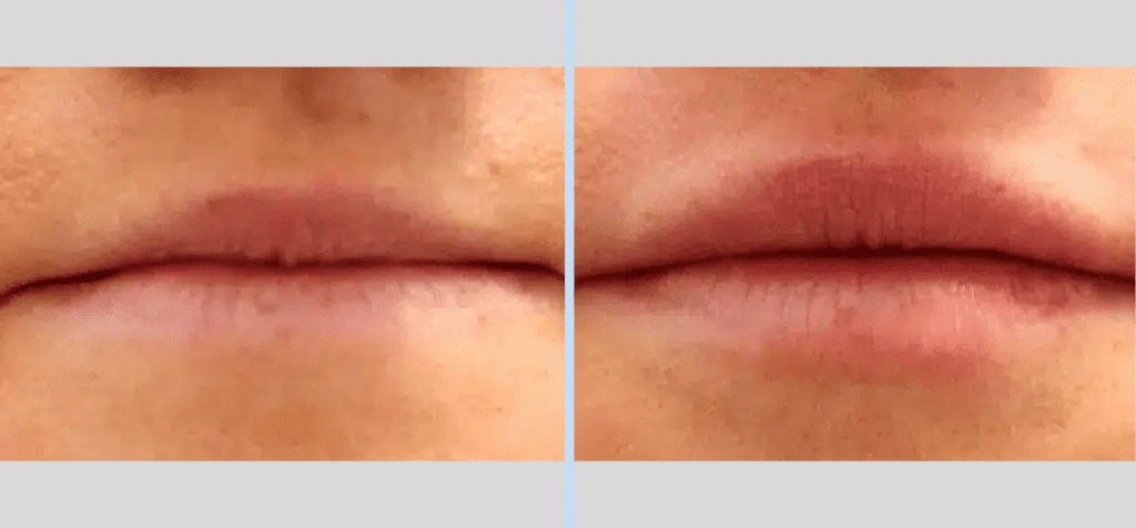 Injectables Before & After – Case 6