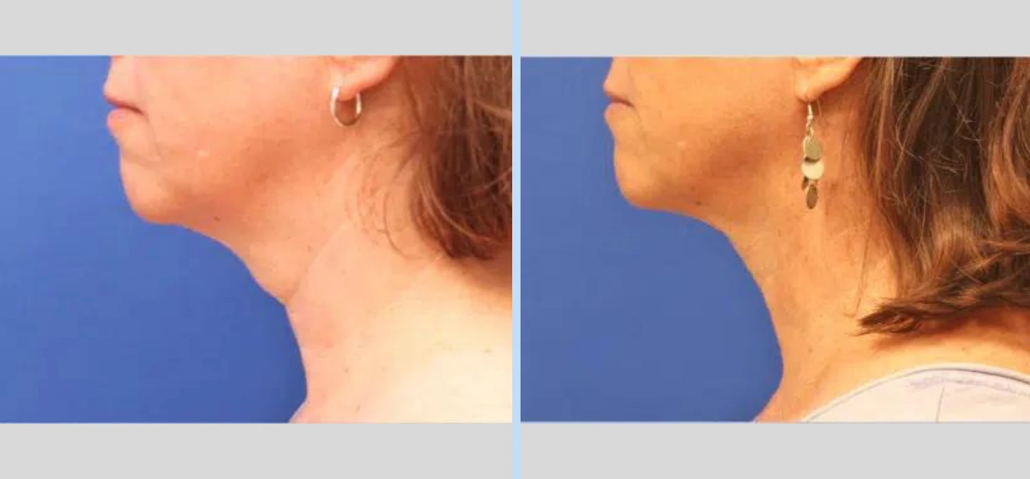 Laser Neck Lift Before & After - Case 1
