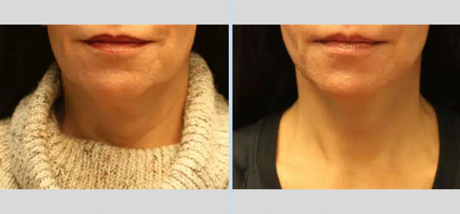 Laser Neck Lift Before & After - Case 2