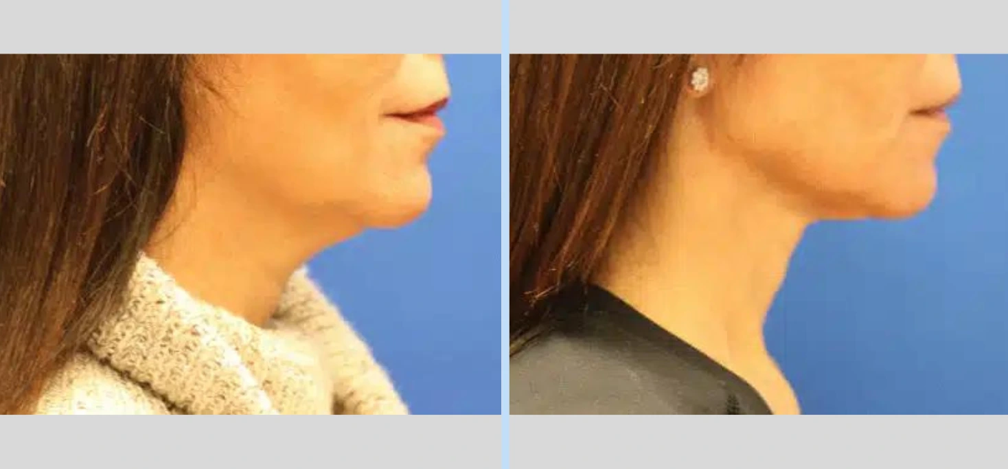 Laser Neck Lift Before & After - Case 2