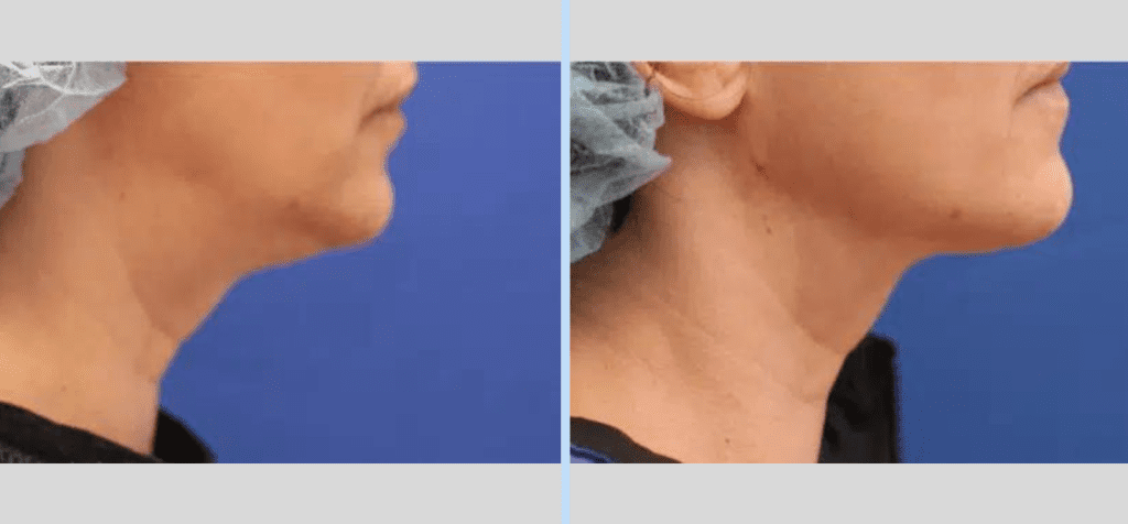 Laser Neck Lift Before & After - Case 3
