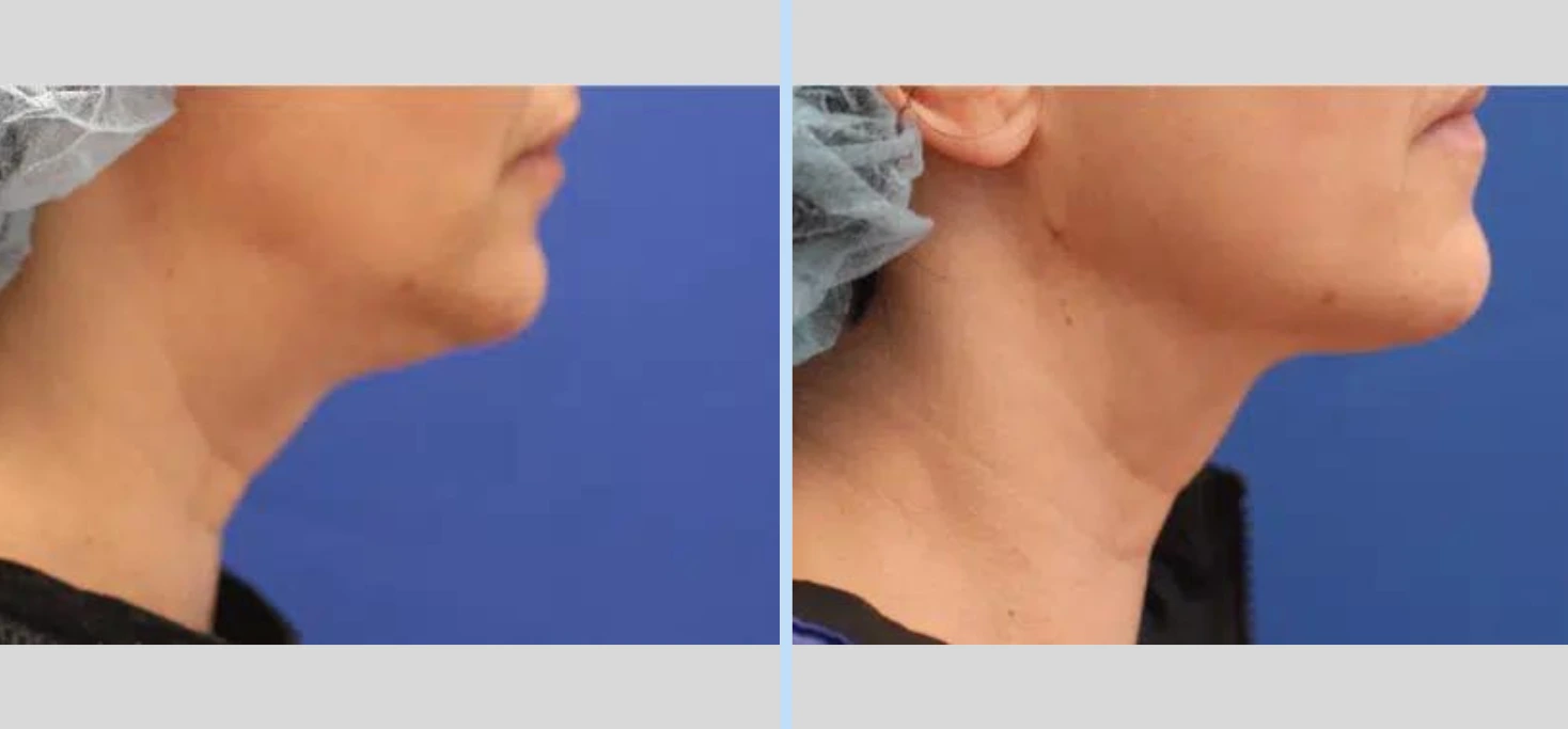 Laser Neck Lift Before & After - Case 3