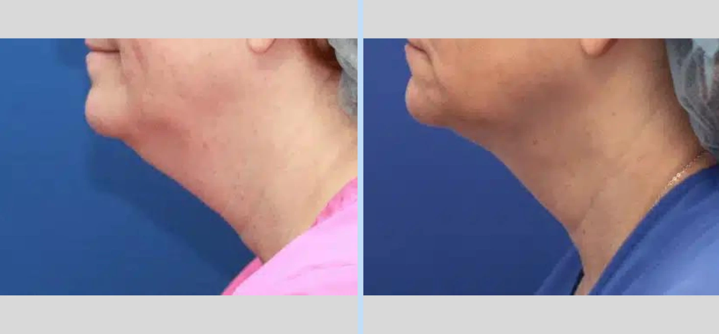 Laser Neck Lift Before & After - Case 4