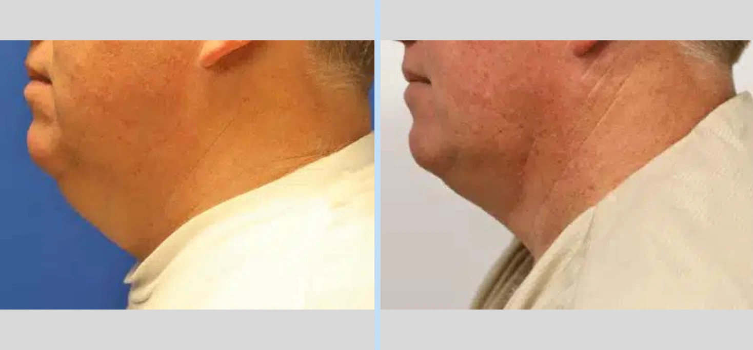 Laser Neck Lift Before & After - Case 5